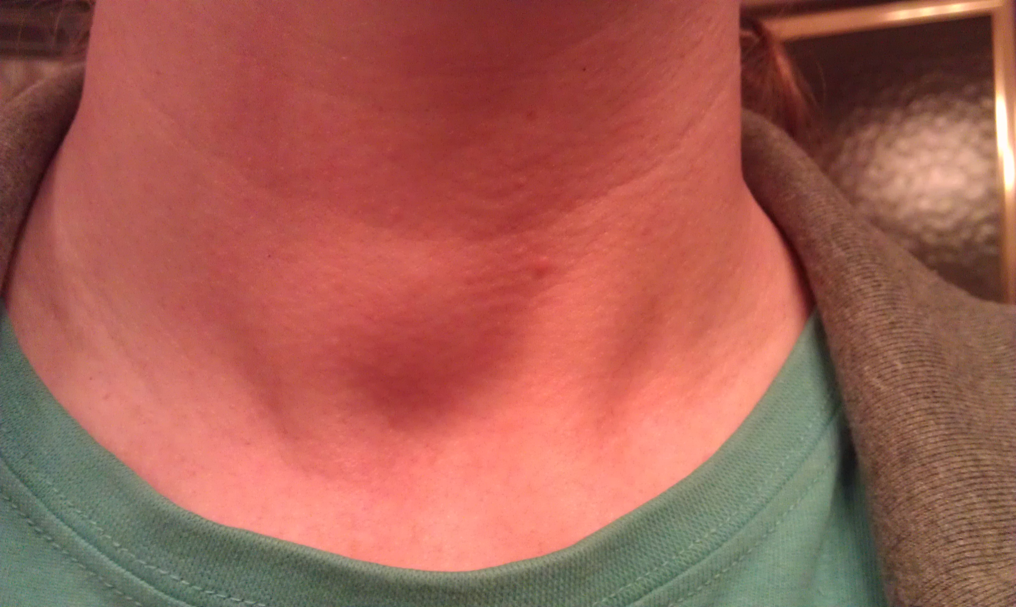 Knot In Throat When Swallowing 119